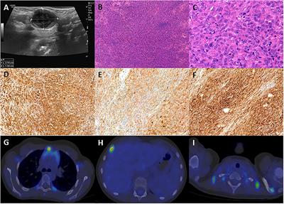 Potential role of MAP2K1 mutation in the trans-differentiation of interdigitating dendritic cell sarcoma: Case report and literature review